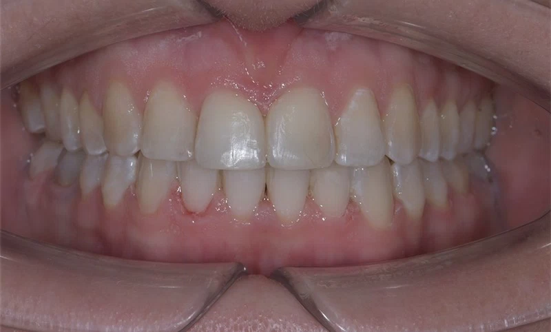 Исправление положения зубов с помощью самолигирующихся брекетов Damon Clear