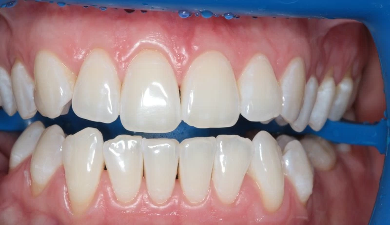Отбеливание зубов системой Zoom4