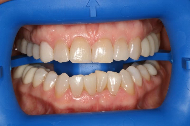 Отбеливание зубов системой Zoom