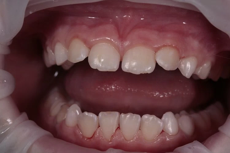 Профессиональная гигиена зубов у детей