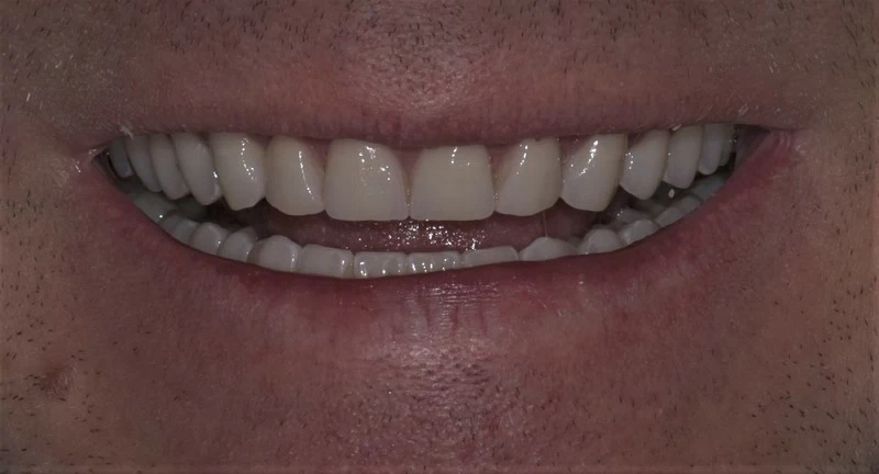 Виниры на зубы