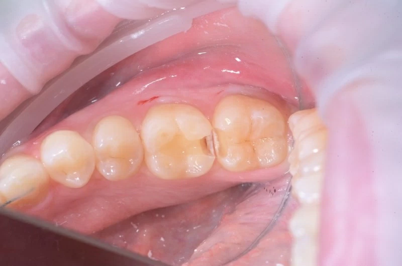 Кариес на контактной поверхности 5 и 6 зубов