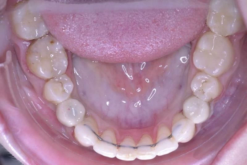 Имплантация двухсторонняя на нижней челюсти. Имплантаты системы Dentium.