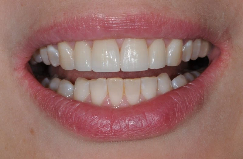 Виниры: новая форма и цвет зубов
