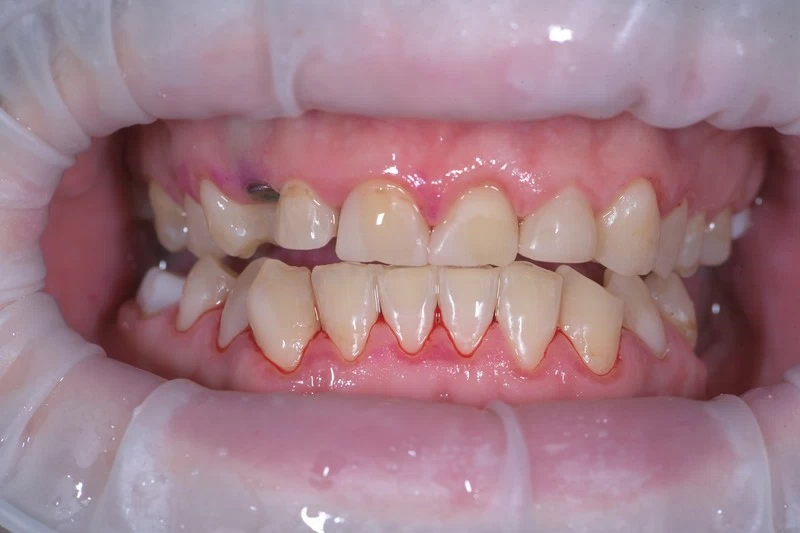 Чистка зубов по протоколу GBT