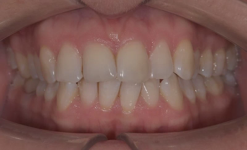 Исправление положения зубов с помощью самолигирующихся брекетов Damon Clear