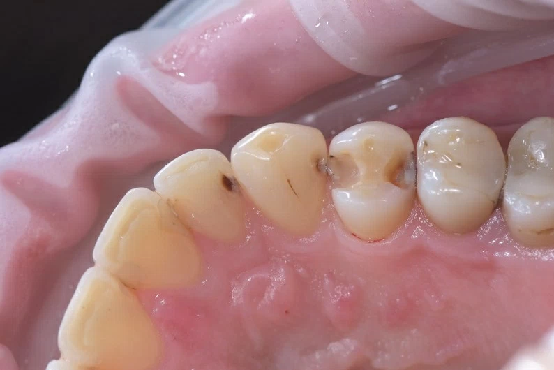 Кариес зубов. Лечение в одно посещение