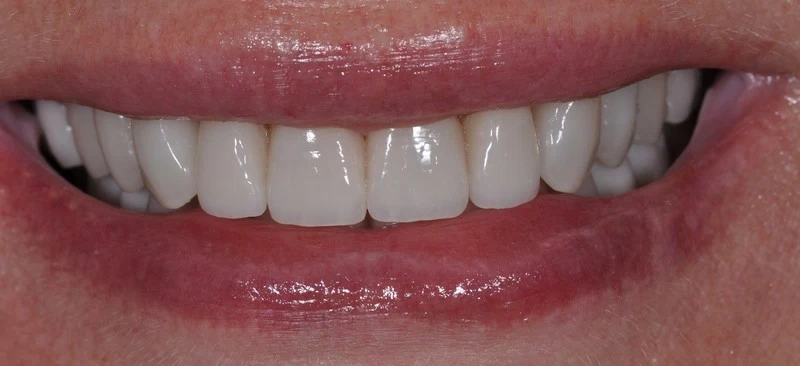 Тотальное преображение зубов
