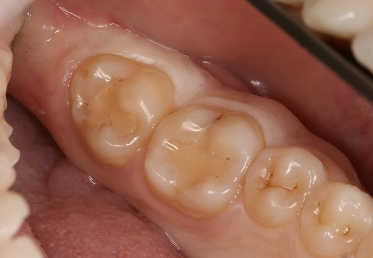 Замена несостоятельных пломб на 6 и 7 зубах