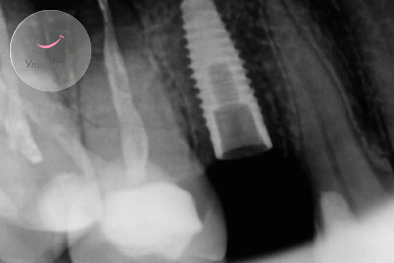 Имплантация 1 зуба