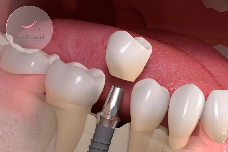 Импланты зубов Штрауман (Straumann)