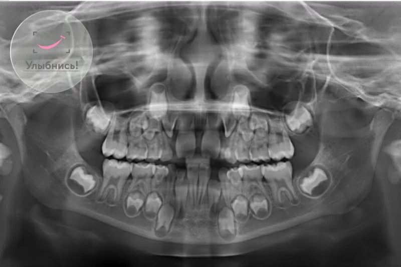 Диагностика зубов у детей