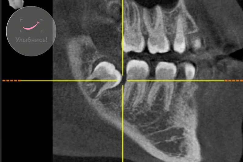 Зубы мудрости: удалять нельзя лечить или пересадить