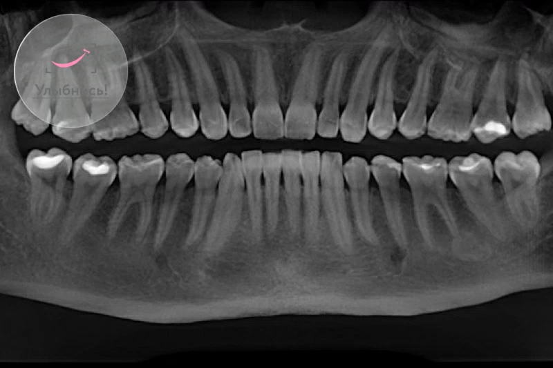 Ортопантомограмма: панорамный снимок зубов