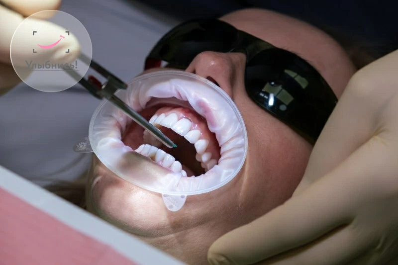Протезирование зубов вкладками