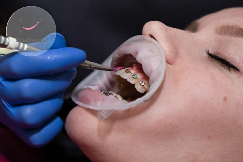 Выравнивание зубов брекетами