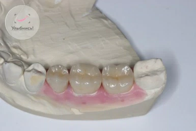 Какие протезы устанавливают при частичном отсутствии зубов
