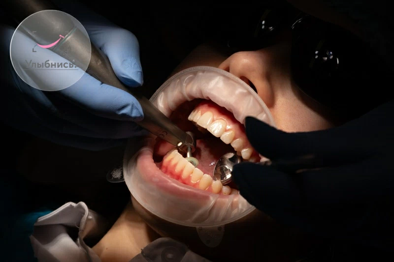 Перфорация корня зуба