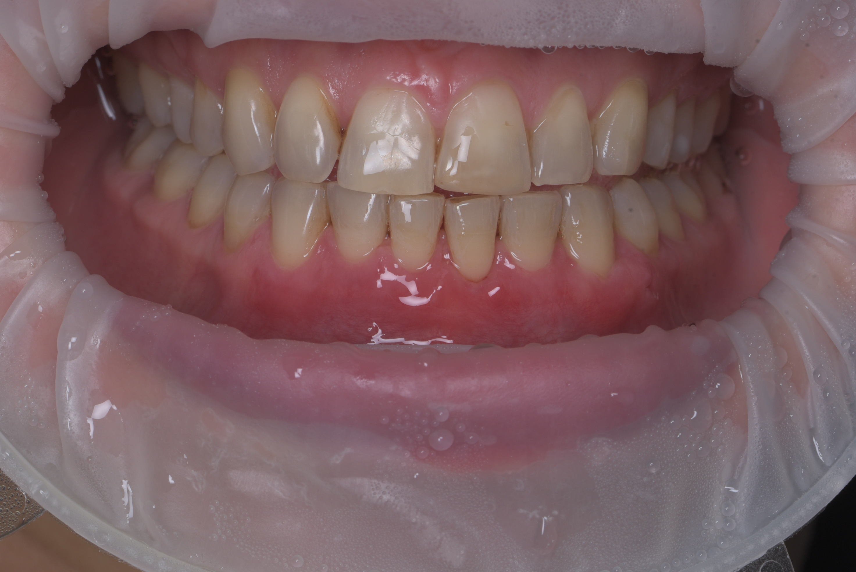 Пластика рецессии на нижнем центральном резце. Работа Бударовой С.А. 