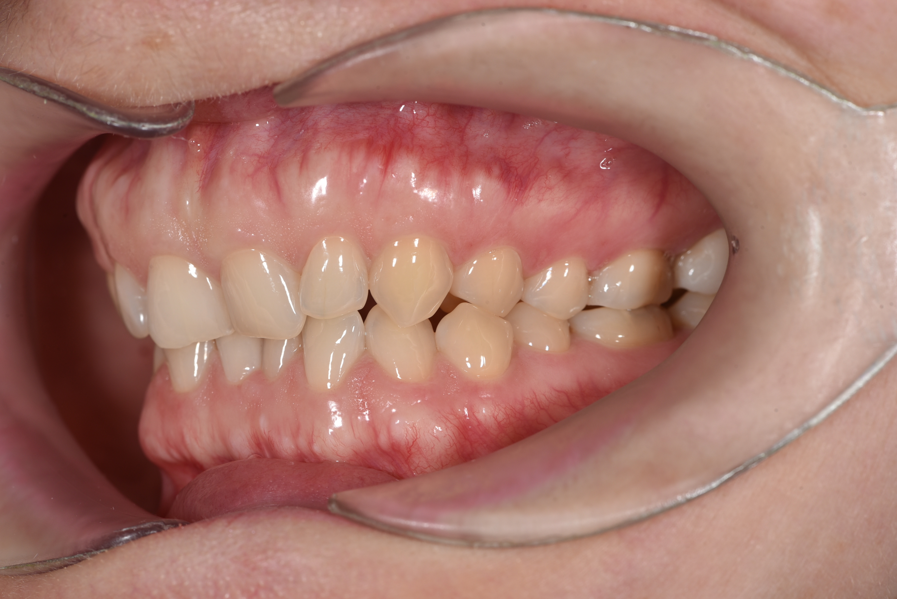 Лечение скученности  дистального прикуса . Брекеты Biomim  Срок лечения 2 года   Врач: Ушакова А.Г.