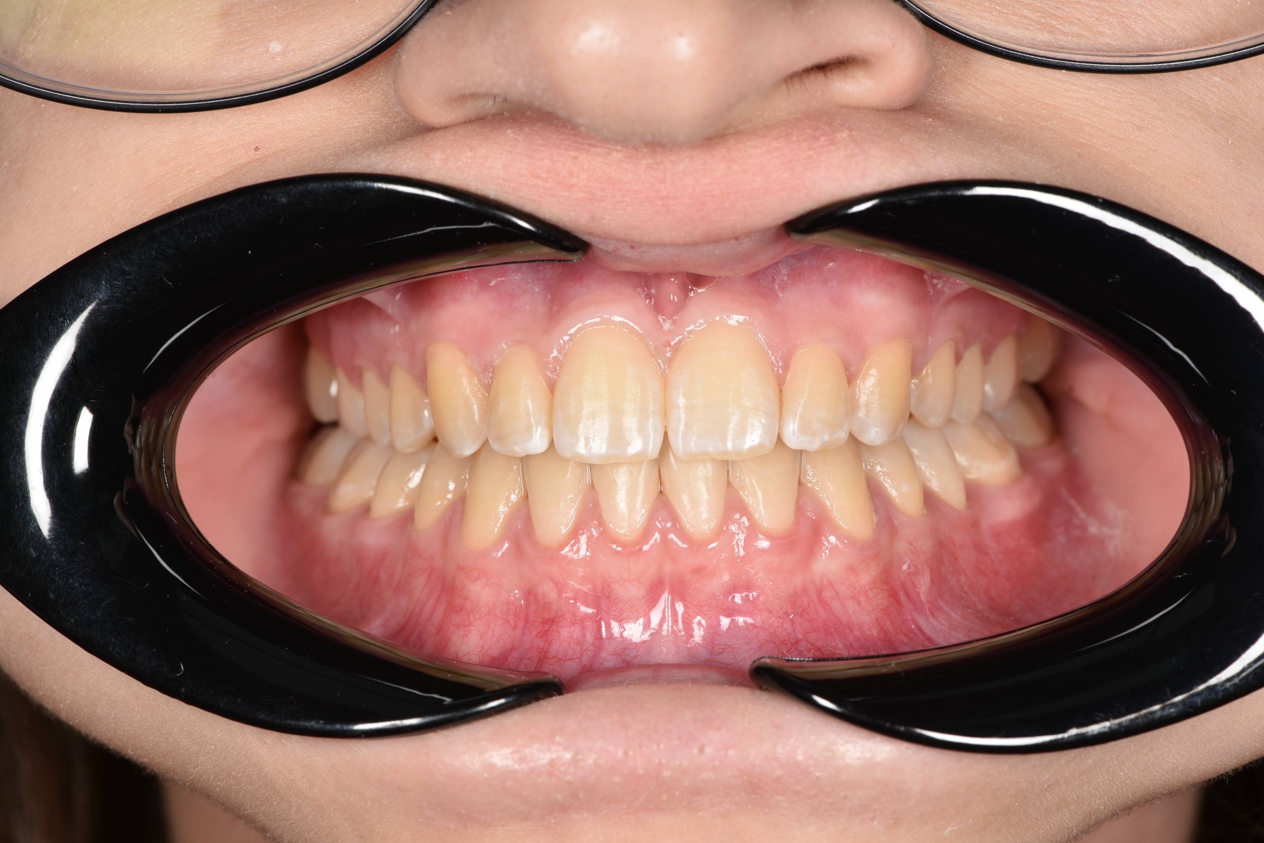 Коррекция мезиального прикуса. Брекеты Damon. Врач: Ушакова А.Г.