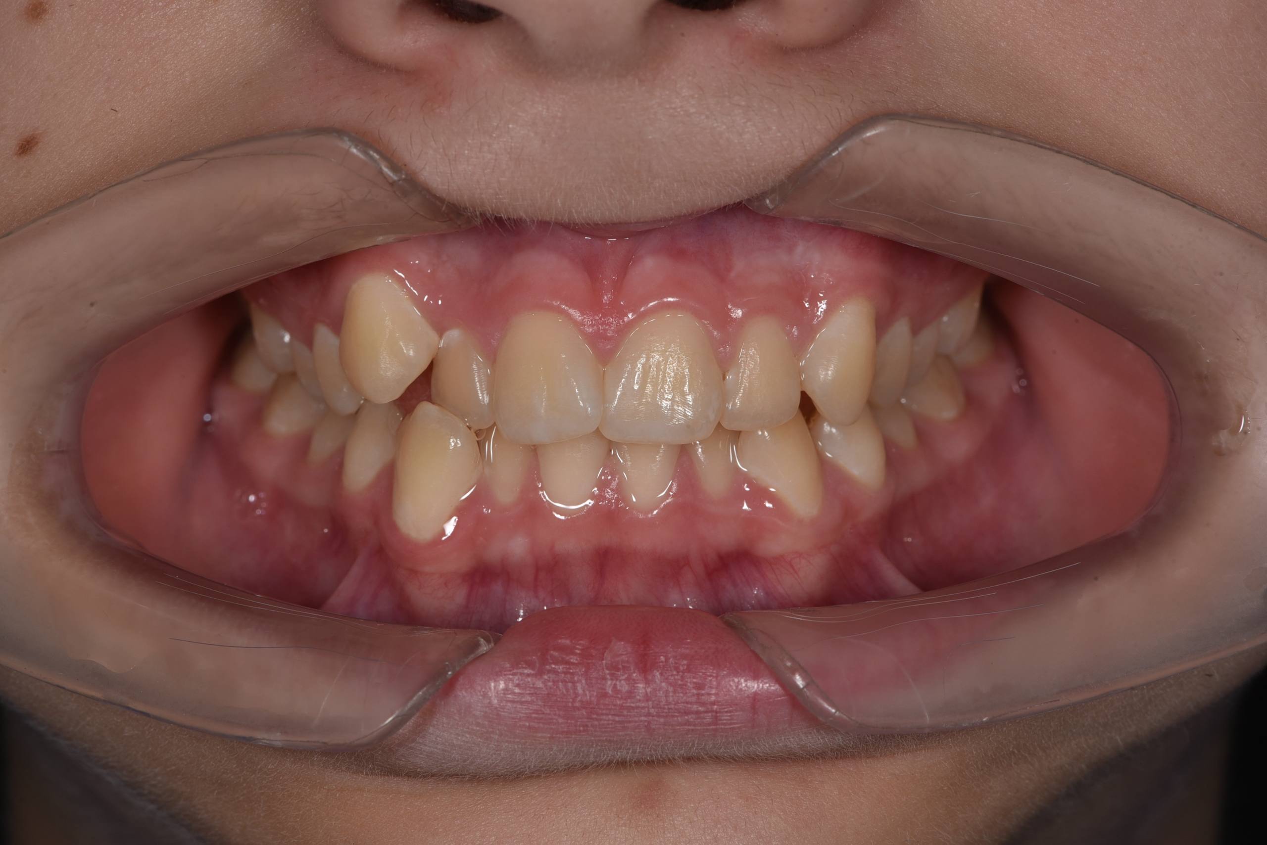 Коррекция скученности и мезиального прикуса у подростка. Брекеты Biomim. Врач: Ушакова А.Г.