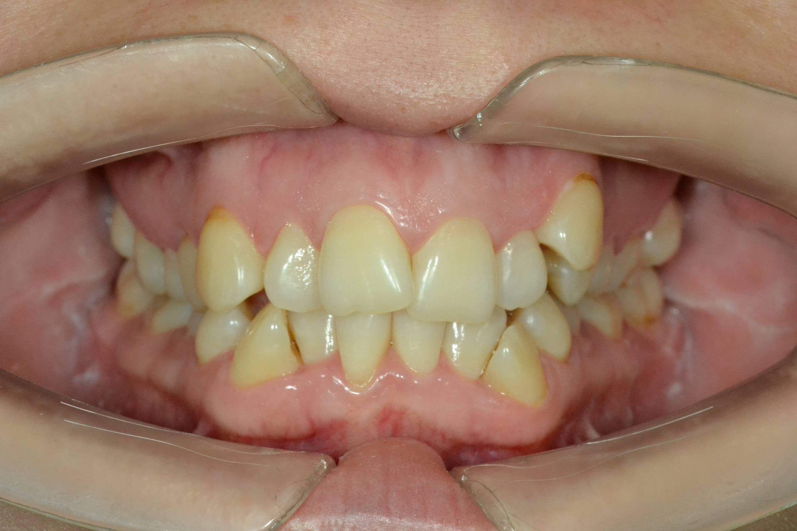 Коррекция скученности. Брекеты Damon. Врач: Ушакова А.Г.