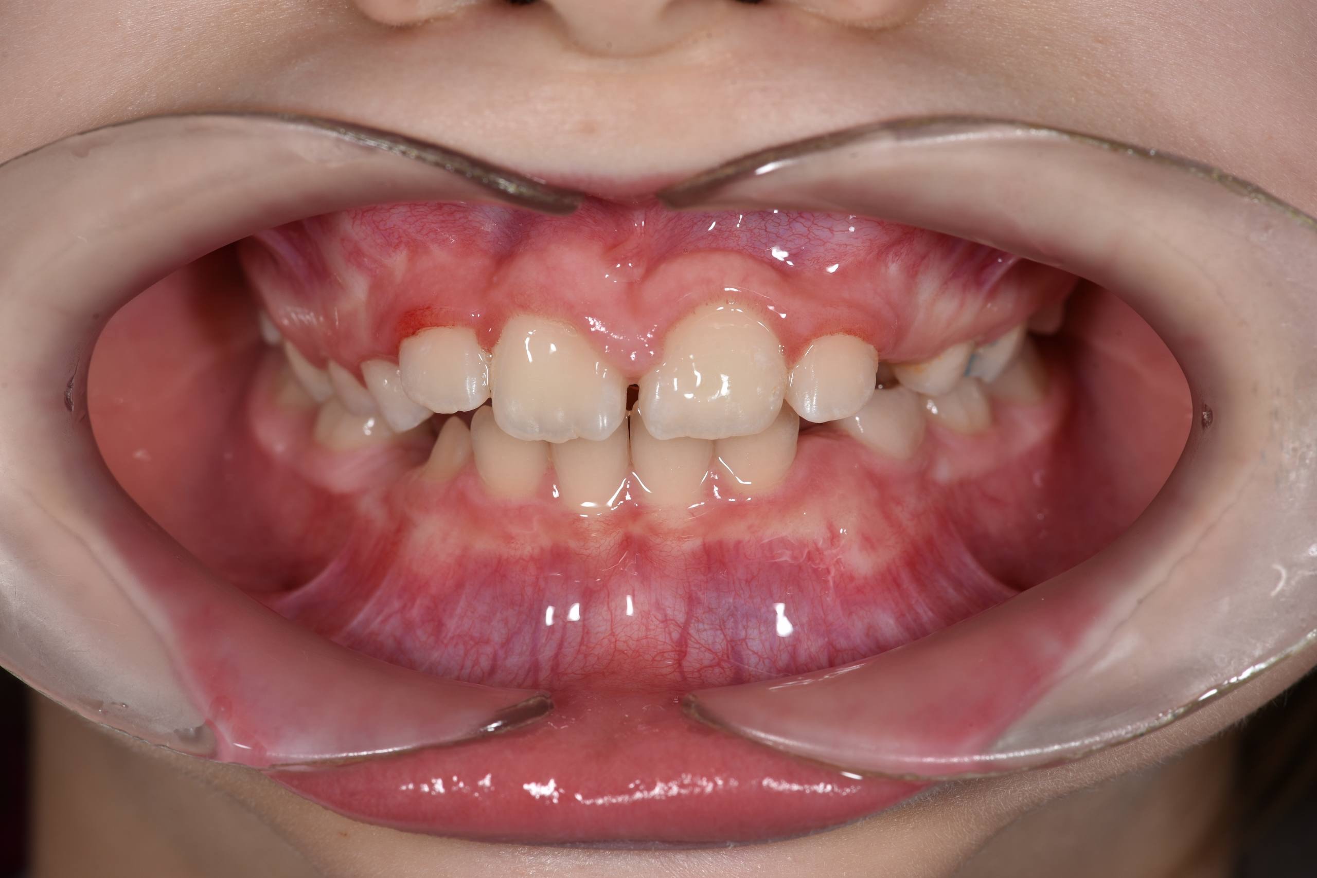 Коррекция положения центрального резца у ребенка. Частичная брекет-система Biomim. Врач: Ушакова А.Г.