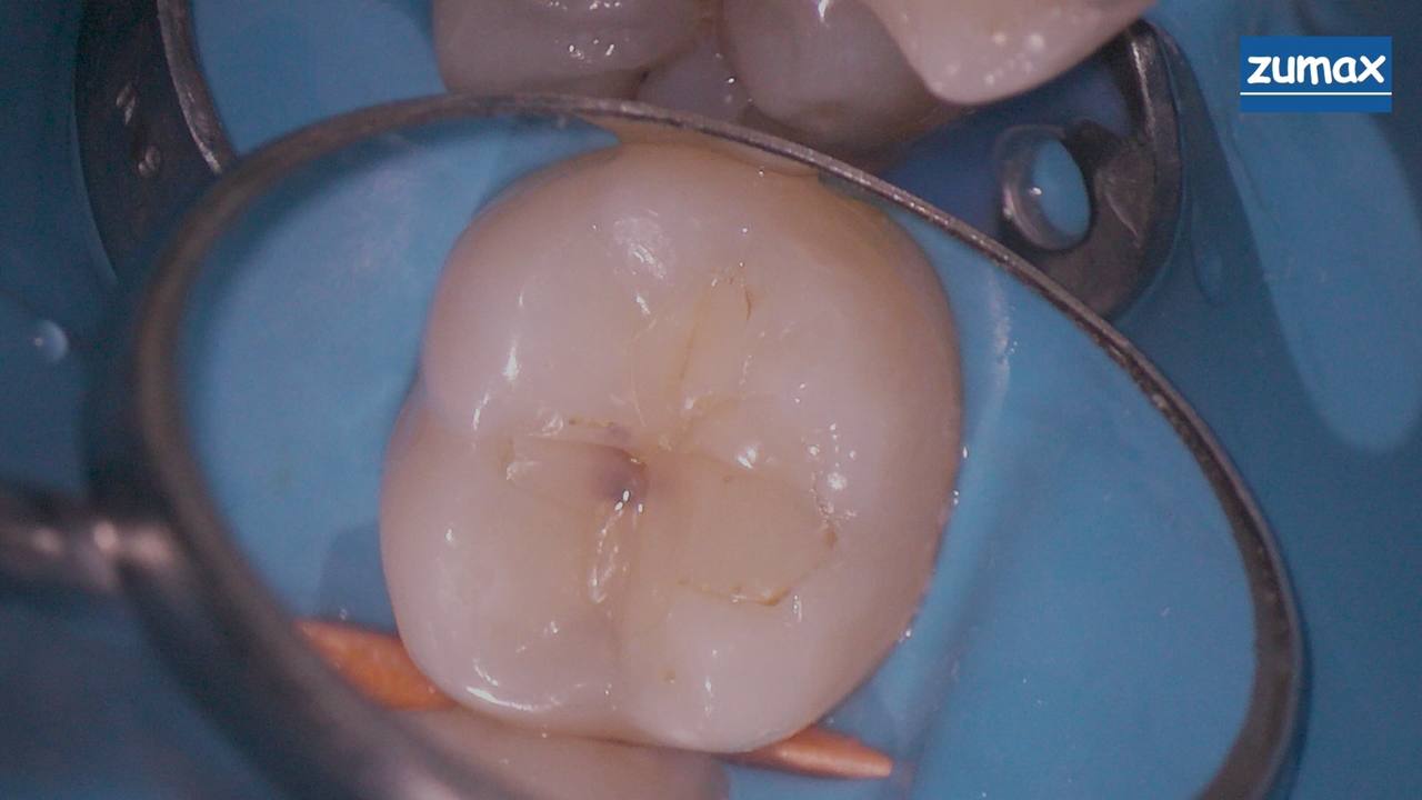 Лечение зубов под микроскопом Фото До и После