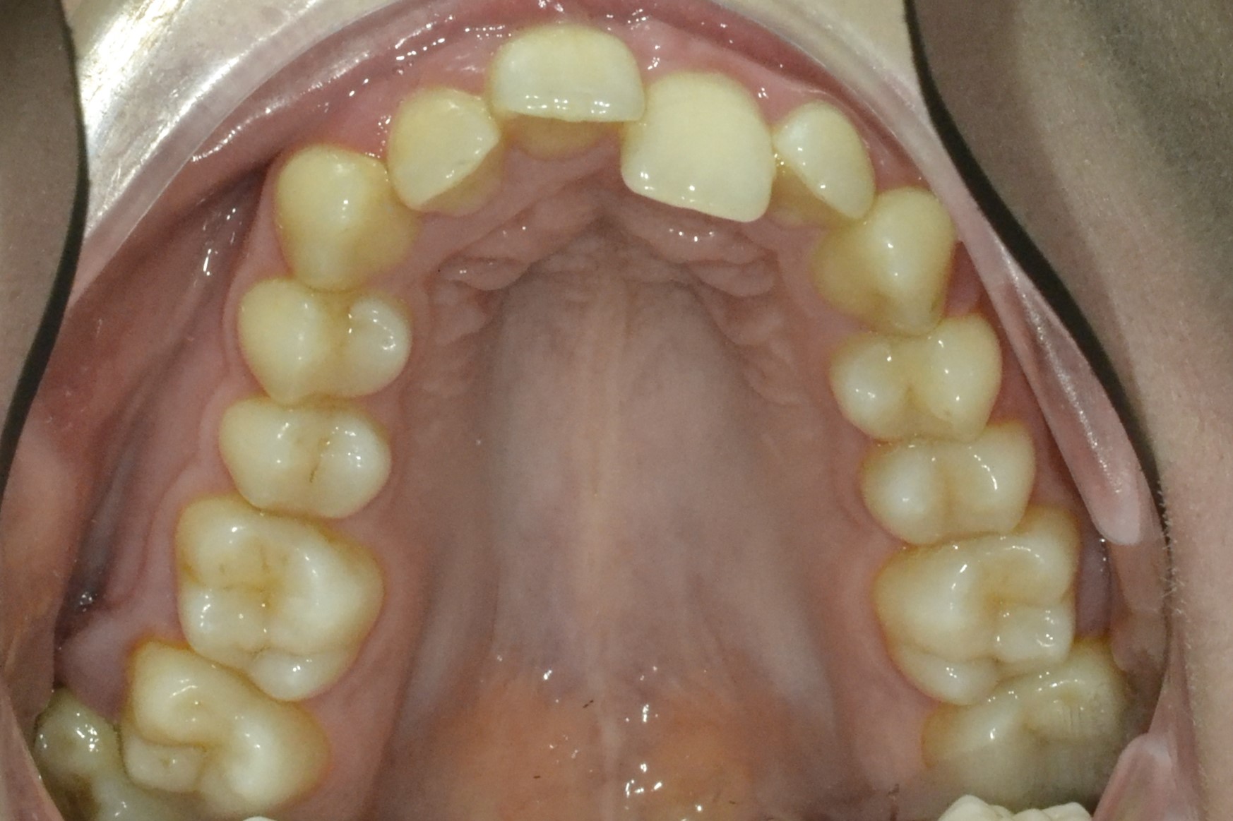 Лечение глубокого прикуса и скученного положения зубов. Брекеты Damon Q.Срок лечения 2 года  Врач: Ушакова А.Г.
