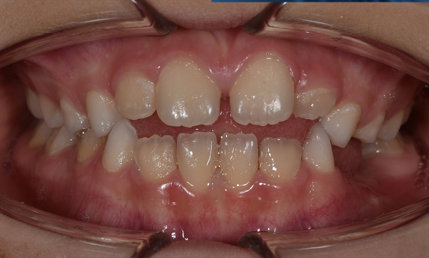 Детское ортодонтическое лечение на активаторе (трейнере). До:прикус открытый. Спустя 2 года:прикус закрылся. Врач: Банузова Т.А.