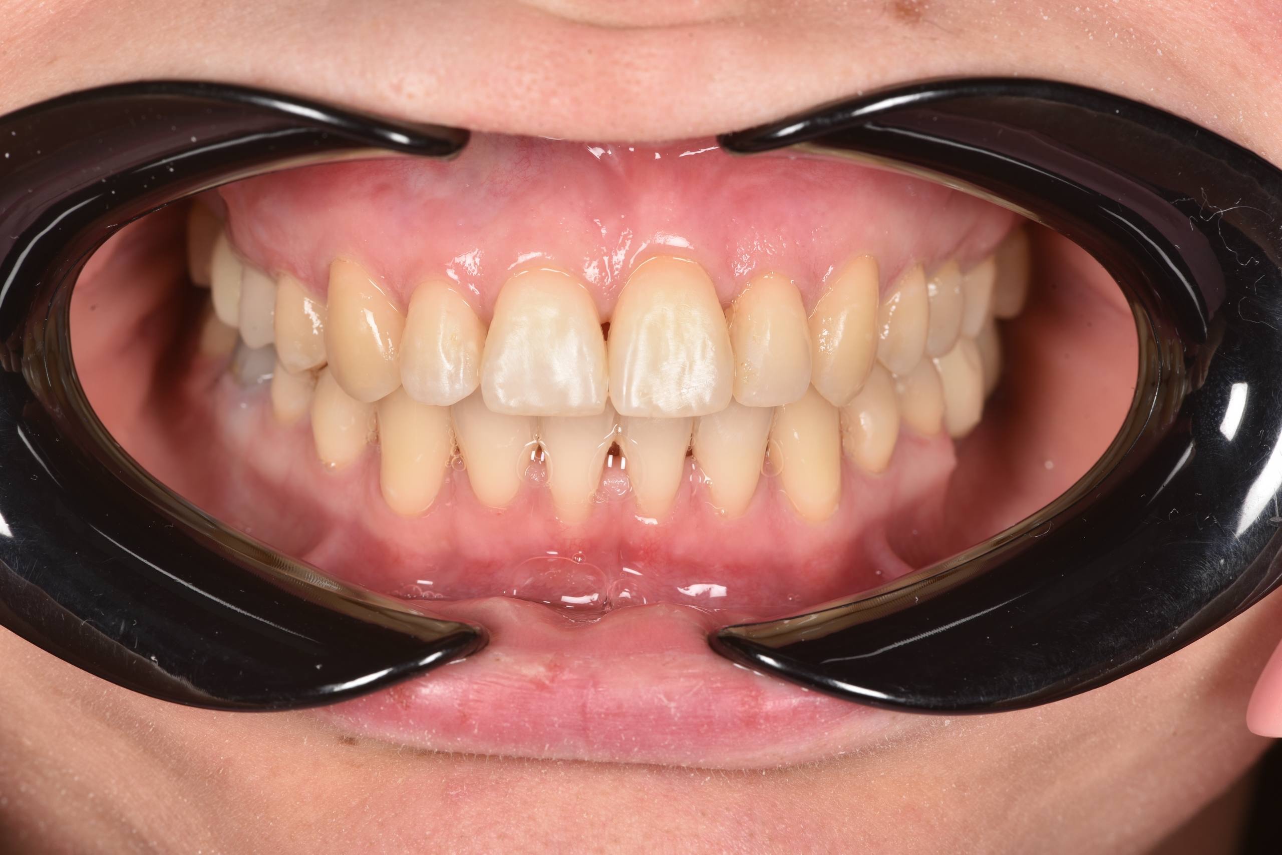 Коррекция центральной линии, асимметричного класса смыкания. Брекеты Damon + минивинт. Врач: Ушакова А.Г.