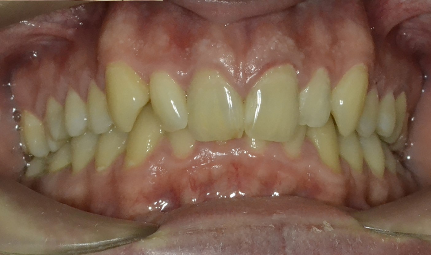 Лечение дистального глубокого прикуса.Брекеты Damon Q + минивинты. Срок лечения 2 года Врач : Ушакова А.Г.