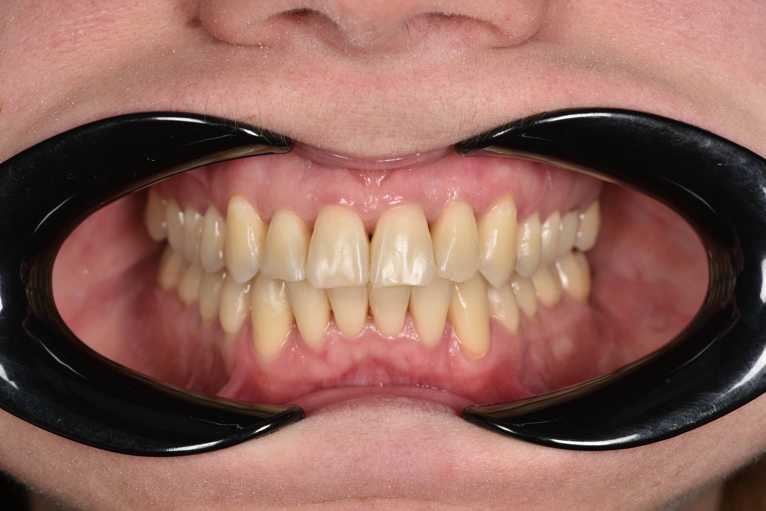 Коррекция скученного положения зубов на верхней и нижней челюсти. Брекеты Damon + минивинт. Врач: Ушакова А.Г.