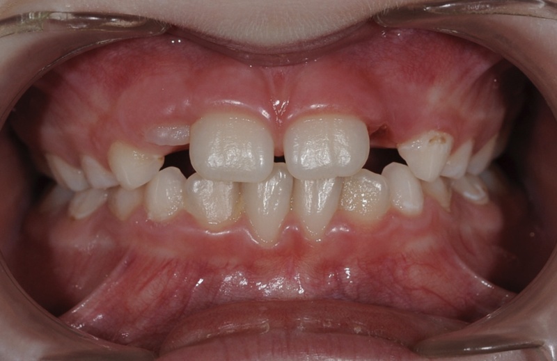 Брекеты на четыре передних зуба у детей Фото До и После