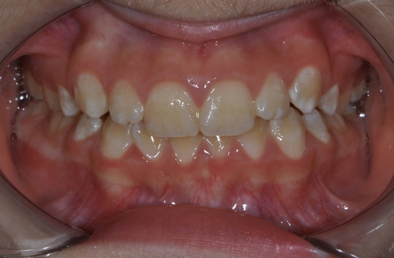 Брекеты на четыре передних зуба у детей Фото До и После