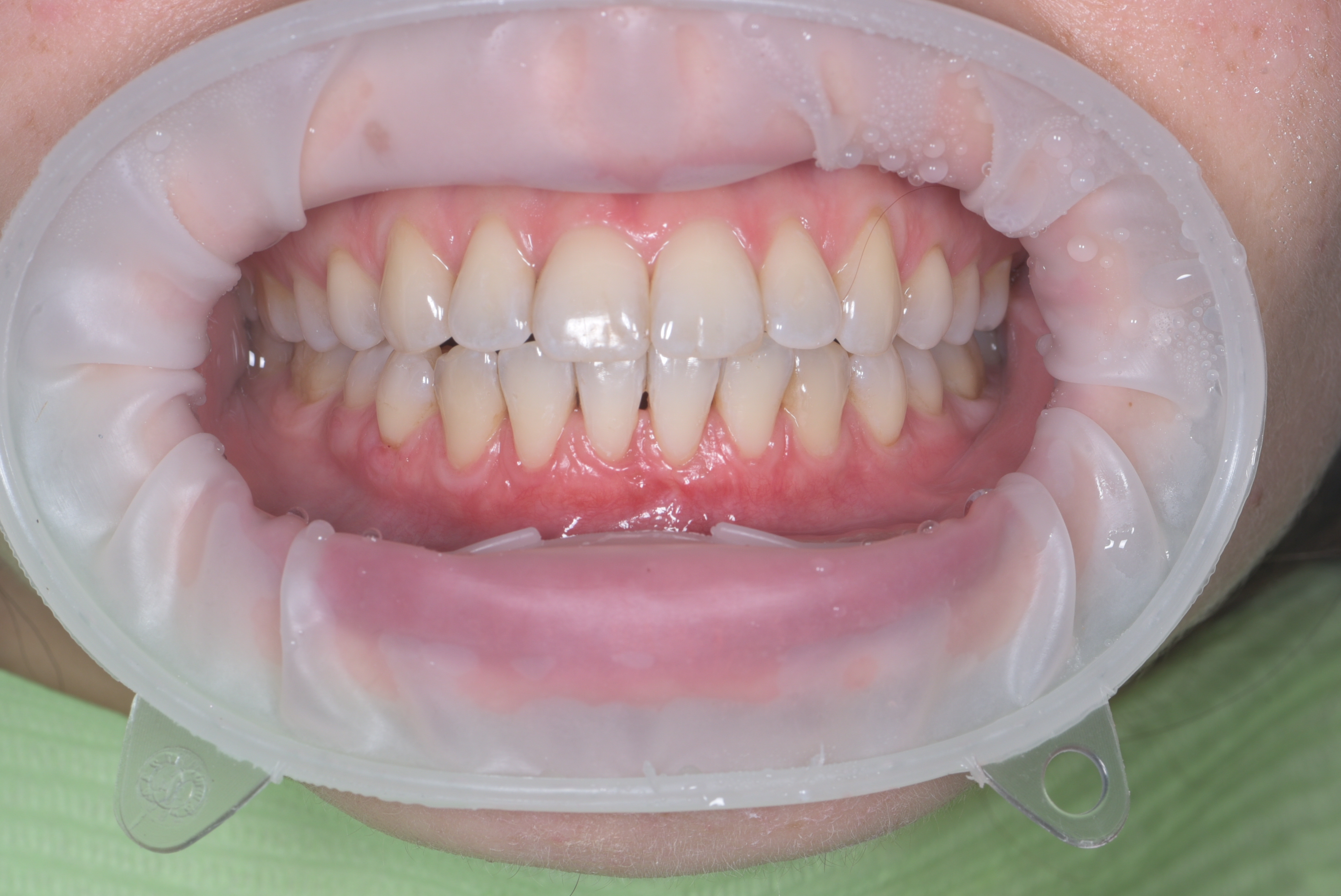 Пластика рецессий на нижних резцах.  Работа врача-хирурга-парадонтолога Бударовой С.А. 