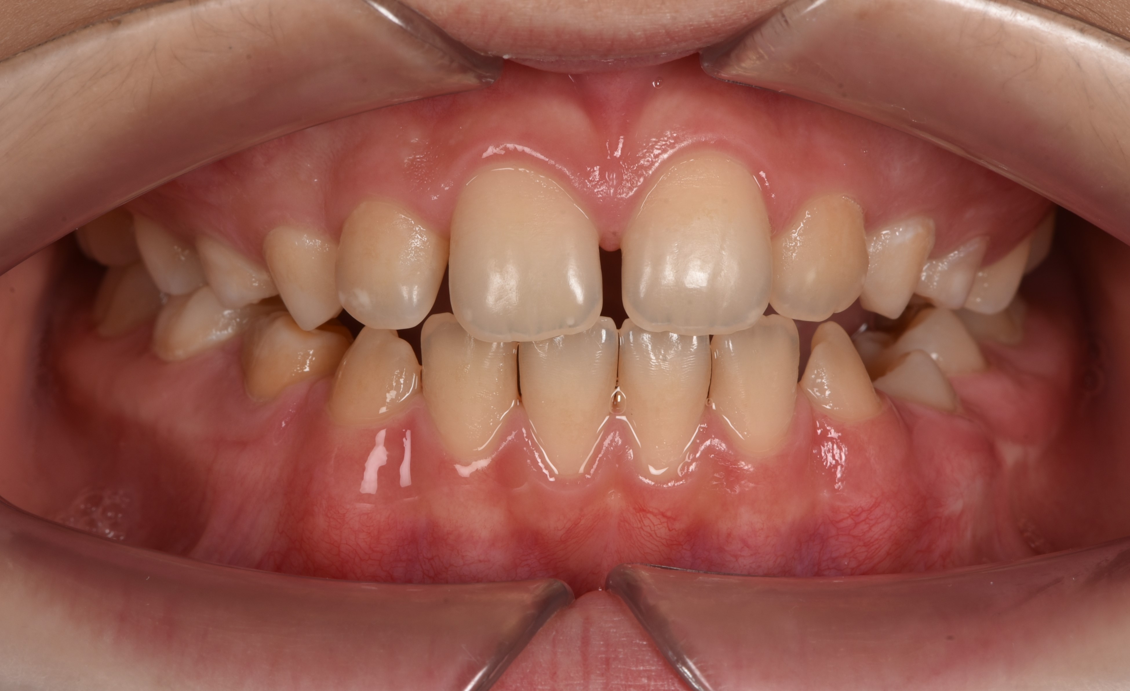 Детское ортодонтическое лечение на активаторе (трейнере). До:прикус открытый. Спустя 2 года:прикус закрылся. Врач: Банузова Т.А.