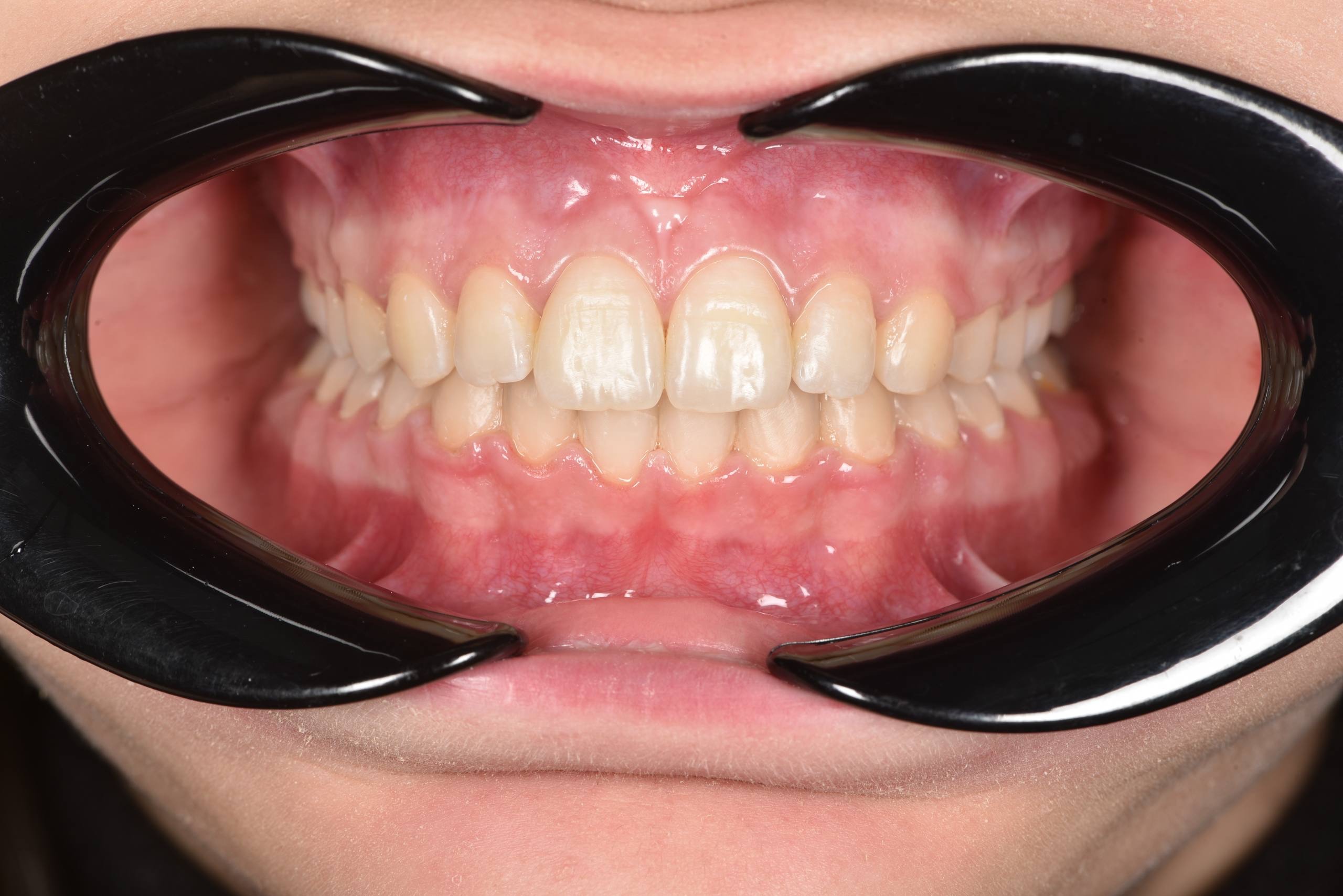 Коррекция центральной линии, дистального прикуса. Брекеты Biomim+ минивинт. Врач: Ушакова А.Г.