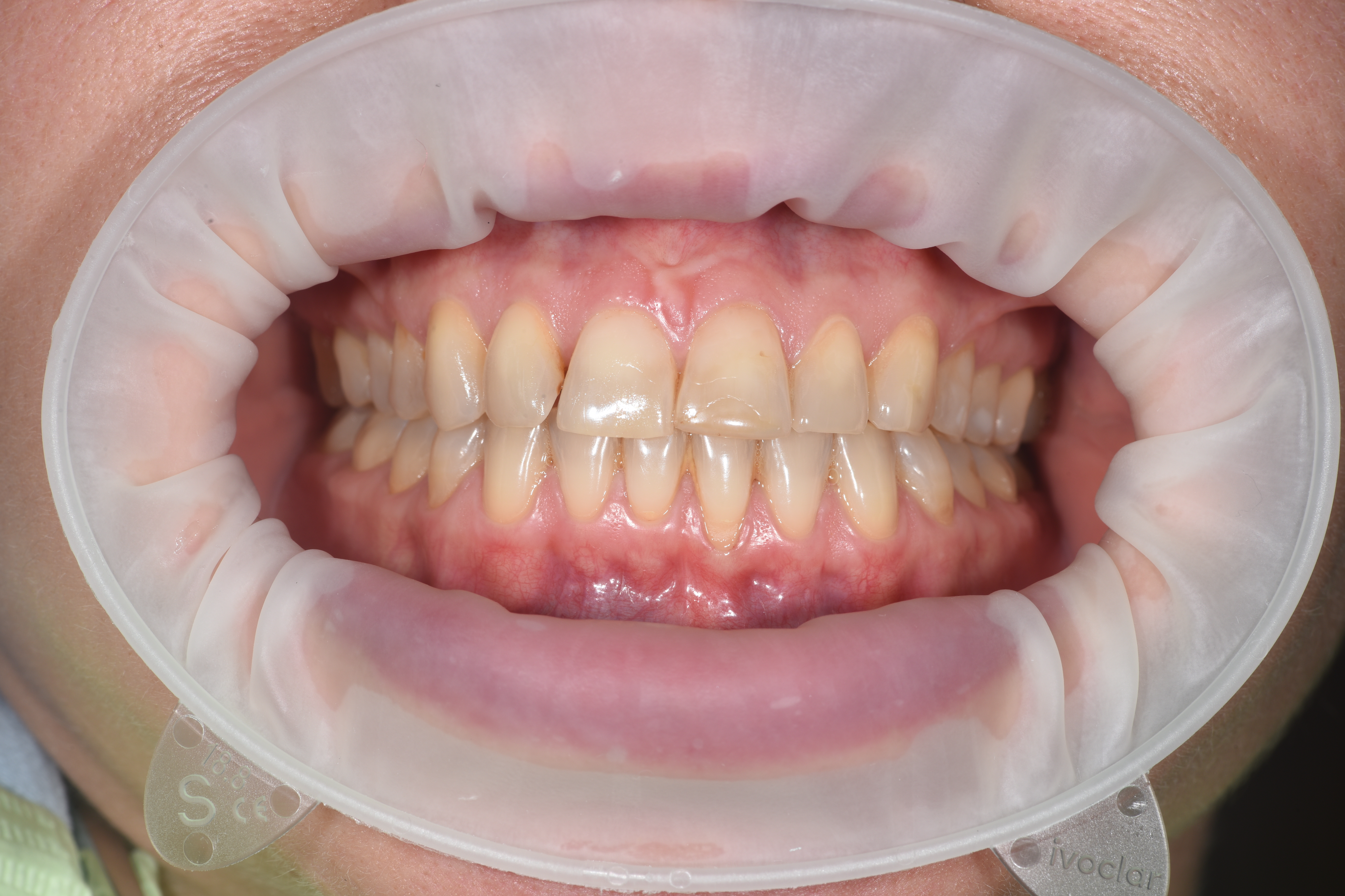 Пластика рецессии на нижнем центральном резце. Работа Бударовой С.А. 