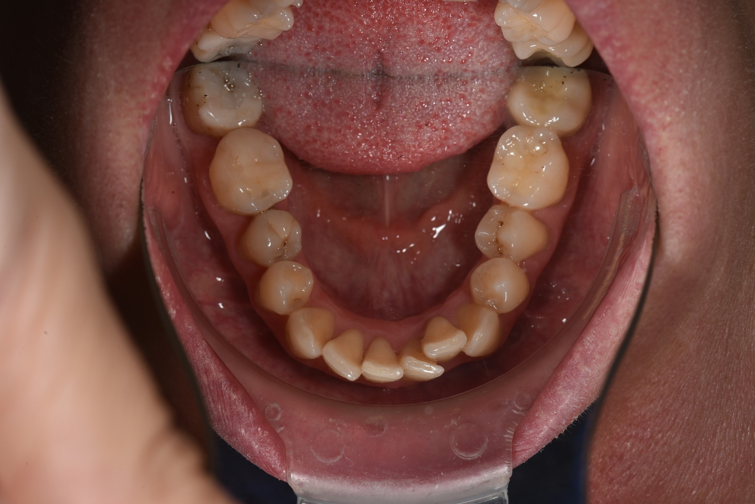 Коррекция скученности  Брекеты Н4 Срок лечения 2 года  Врач: Ушакова А.Г. 