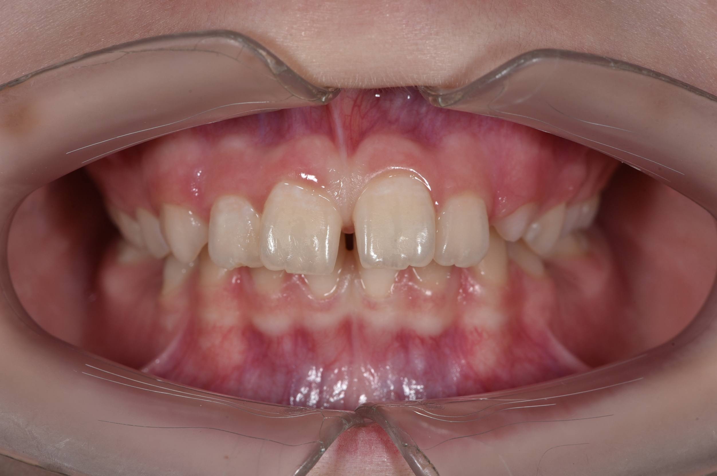 Коррекция дистального прикуса у подростка. Брекеты Damon. Врач: Ушакова А.Г.