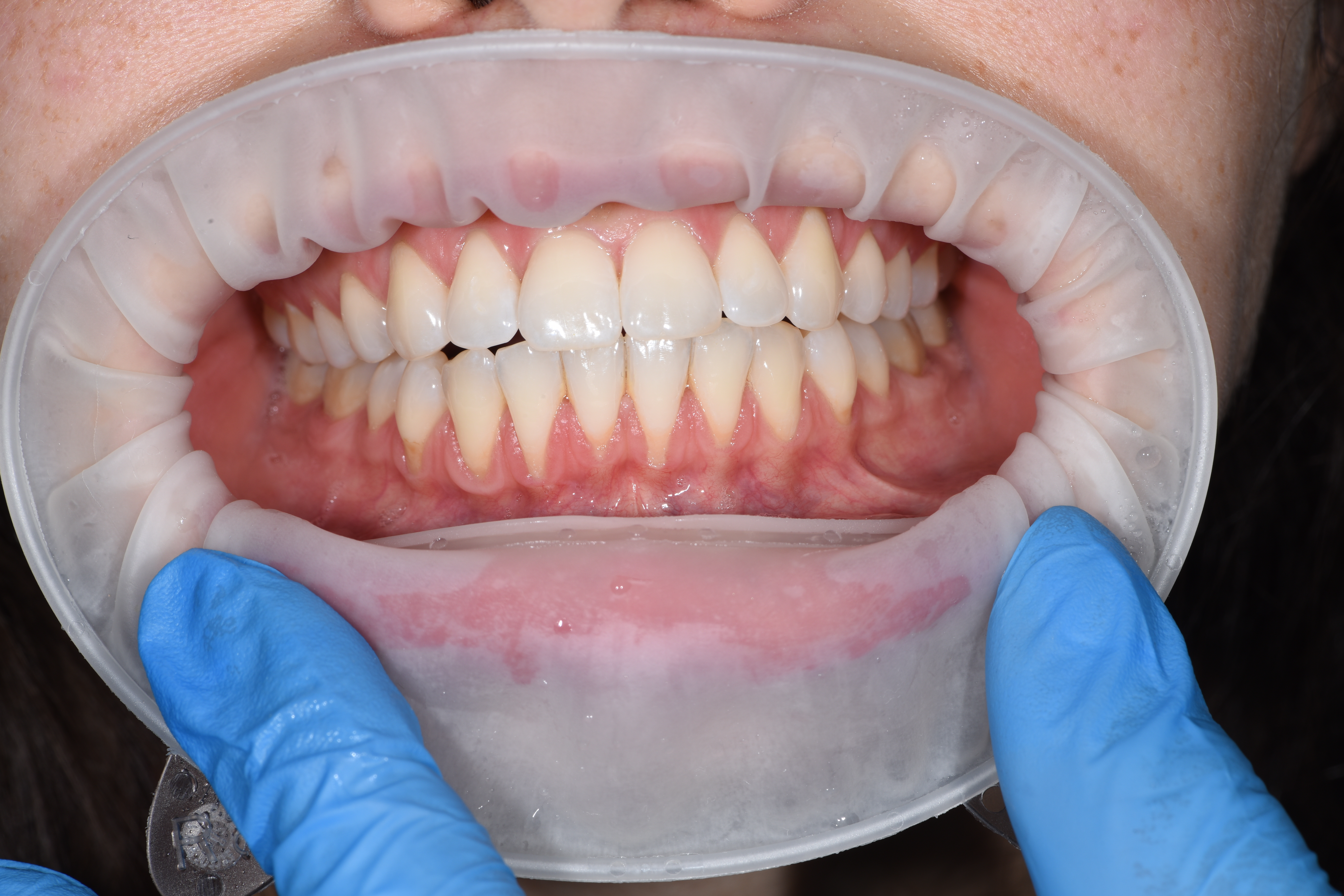 Пластика рецессий на нижних резцах.  Работа врача-хирурга-парадонтолога Бударовой С.А. 