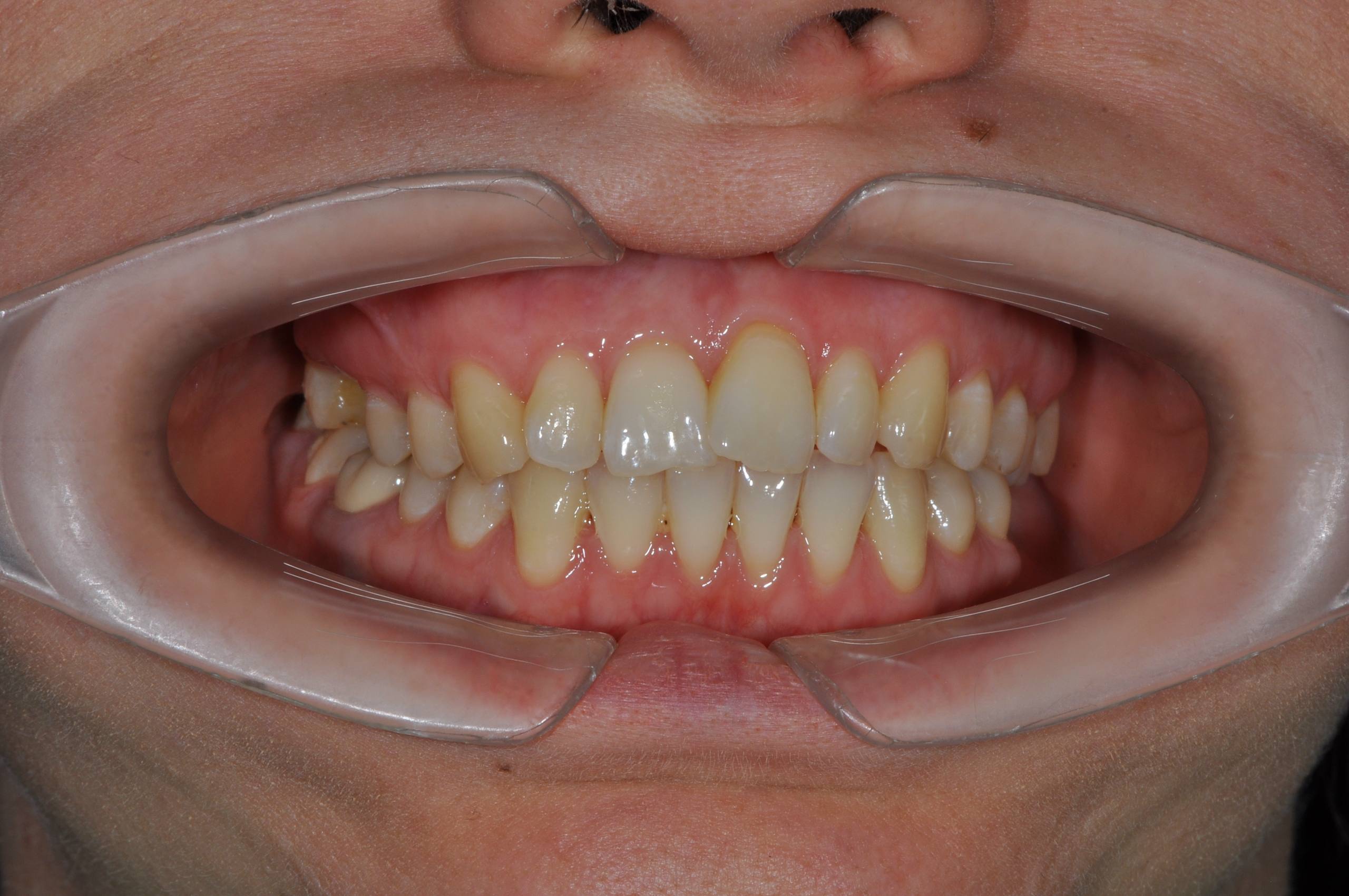 Коррекция центральной линии, асимметричного класса смыкания. Брекеты Damon + минивинт. Врач: Ушакова А.Г.