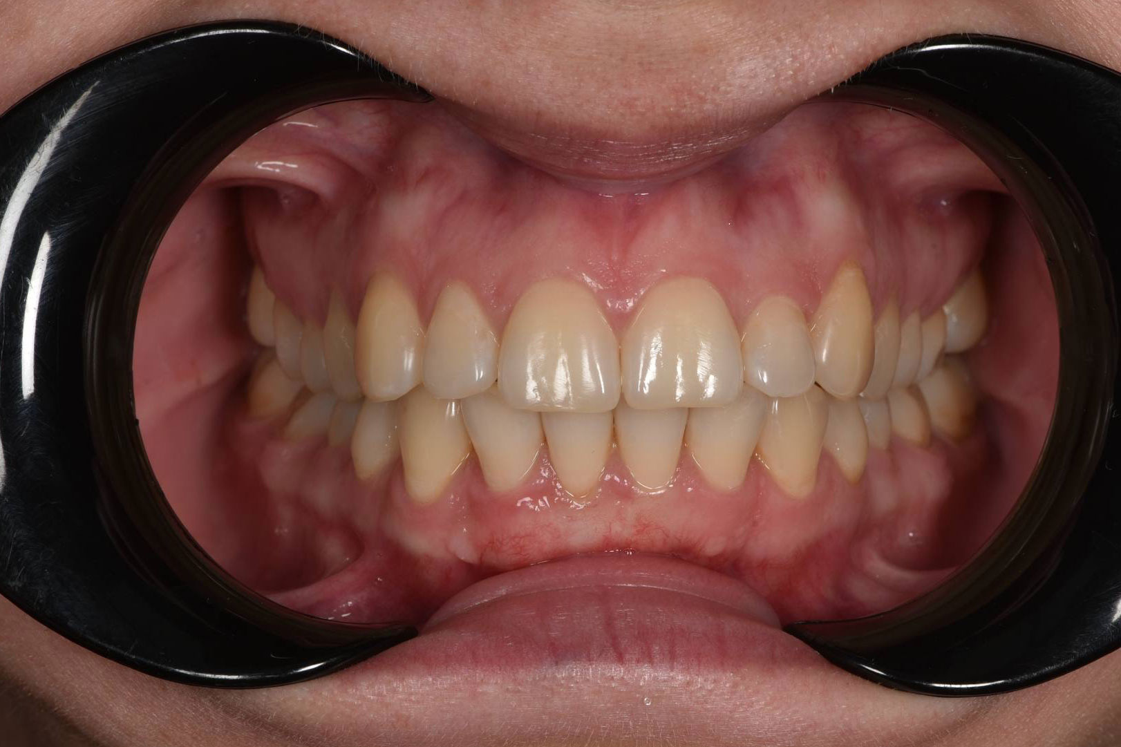 Коррекция скученности. Брекеты Damon. Врач: Ушакова А.Г.