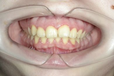 Ортодонтическая диагностика Фото До и После