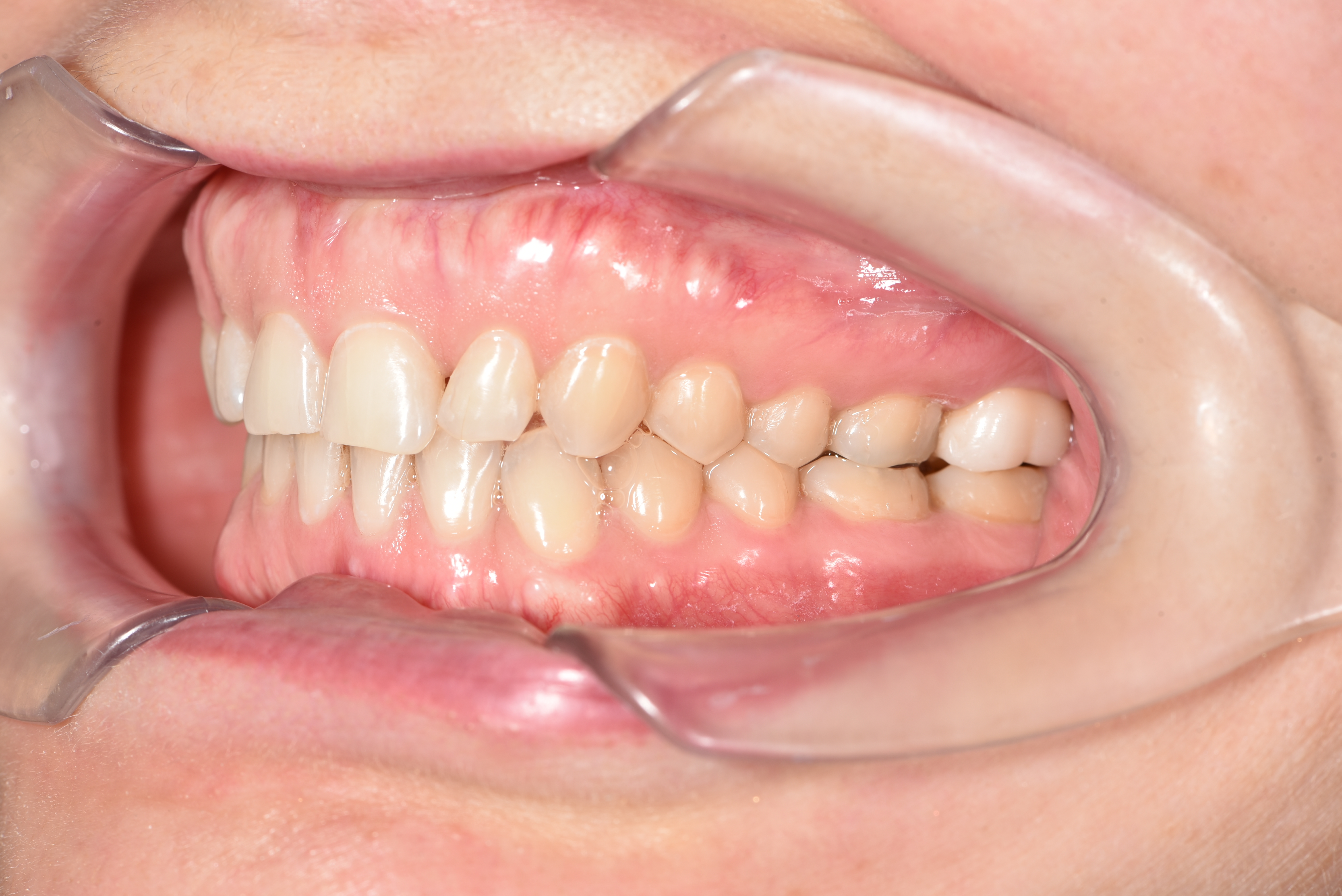 Лечение скученности  дистального прикуса . Брекеты Biomim  Срок лечения 2 года   Врач: Ушакова А.Г.