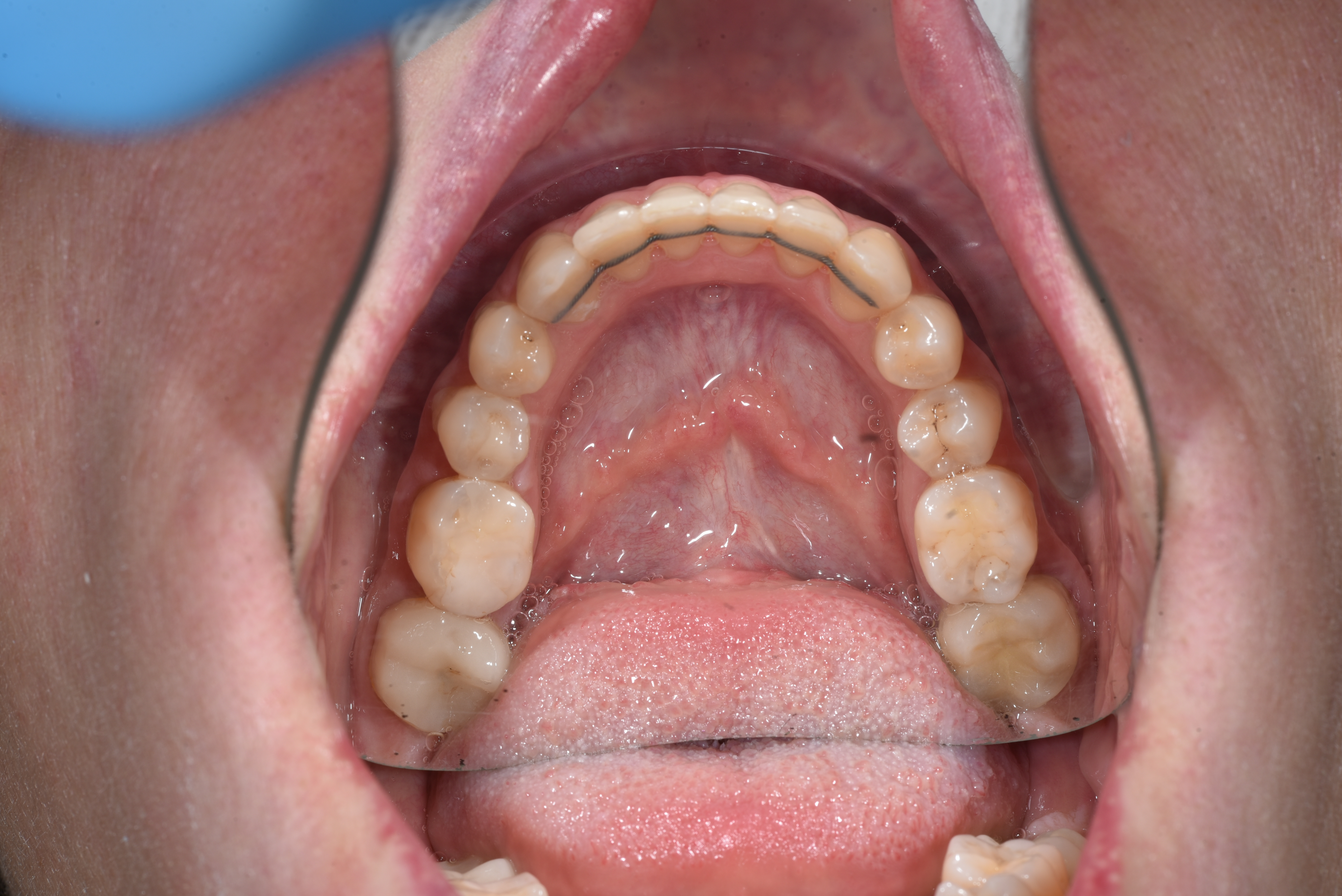 Коррекция скученности  Брекеты Н4 Срок лечения 2 года  Врач: Ушакова А.Г. 