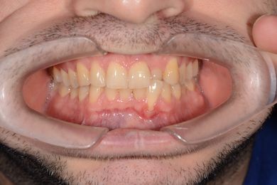 Ортодонтическая диагностика Фото До и После