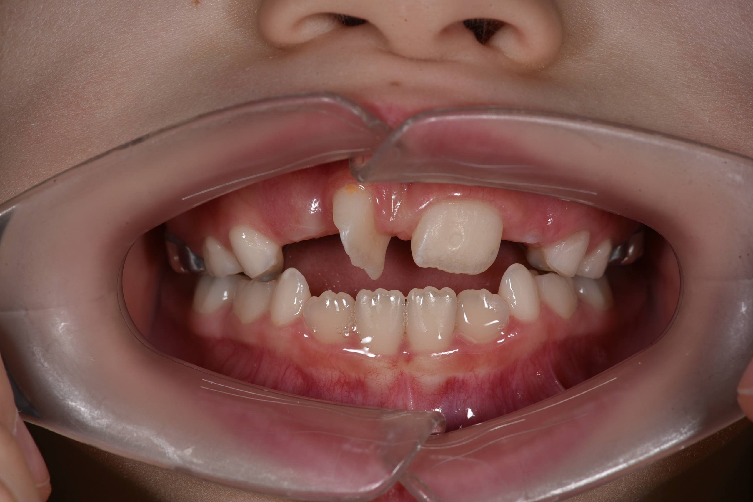 Коррекция положения центрального резца у ребенка. Частичная брекет-система Biomim. Врач: Ушакова А.Г.